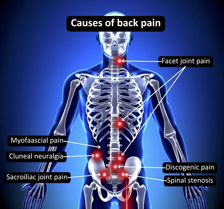 back pain homeopathic treatment Dorval